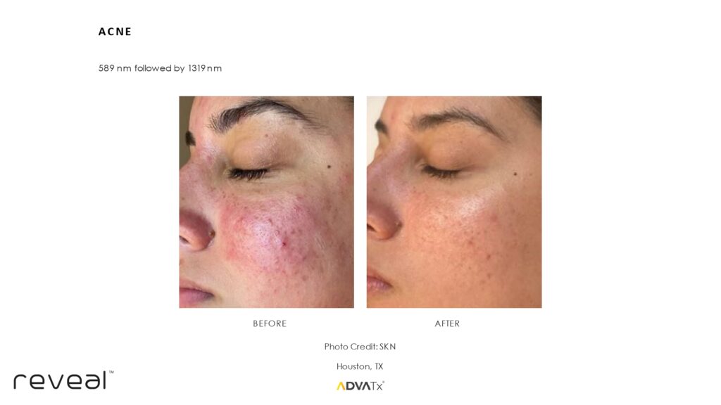 Before and after ADVATx results