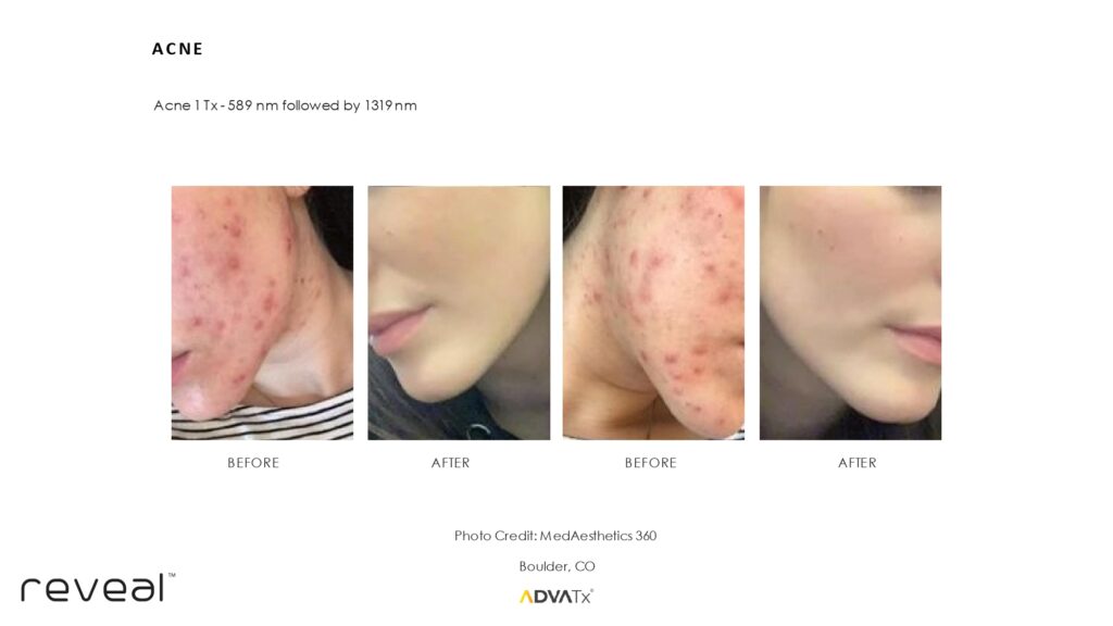 Before and after ADVATx results
