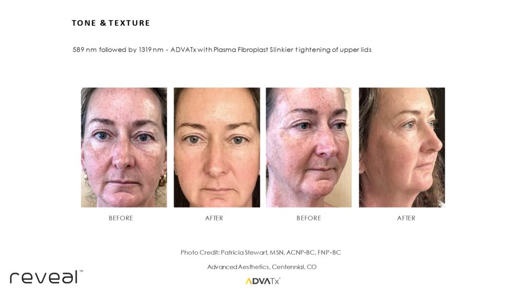 Before and after ADVATx results