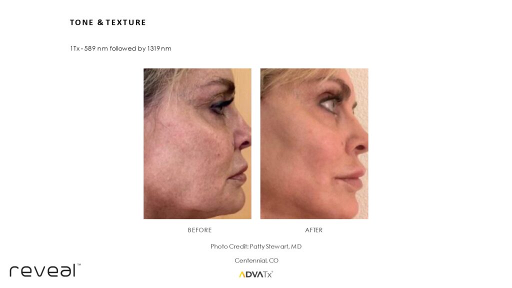Before and after ADVATx results