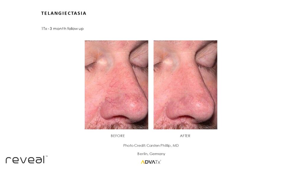Before and after ADVATx results