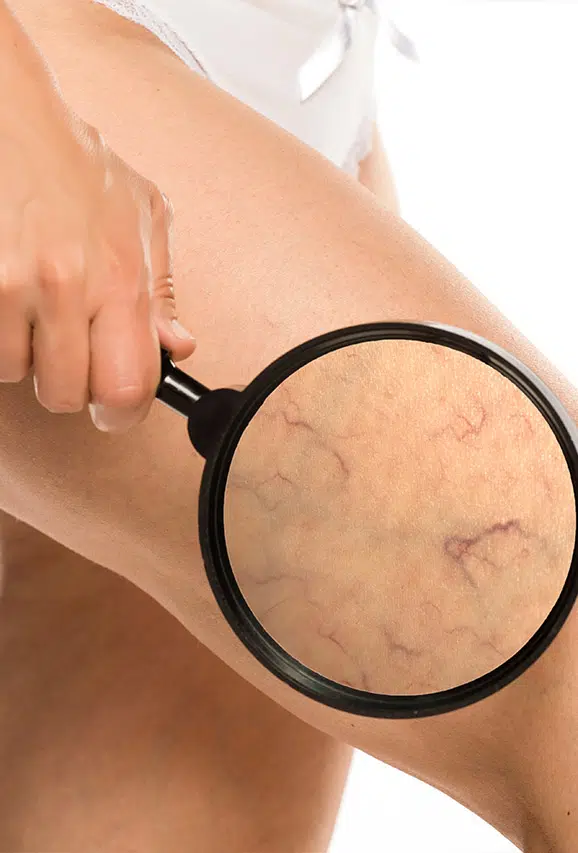 Photo of a woman holding up a magnifying glass to her leg veins