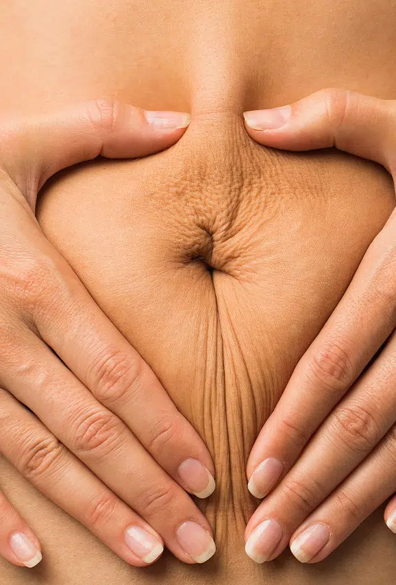 Photo of loose skin on a woman's stomach