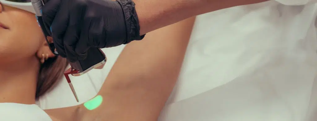 Photo of a woman getting AlloraPro™ laser hair removal on her armpit