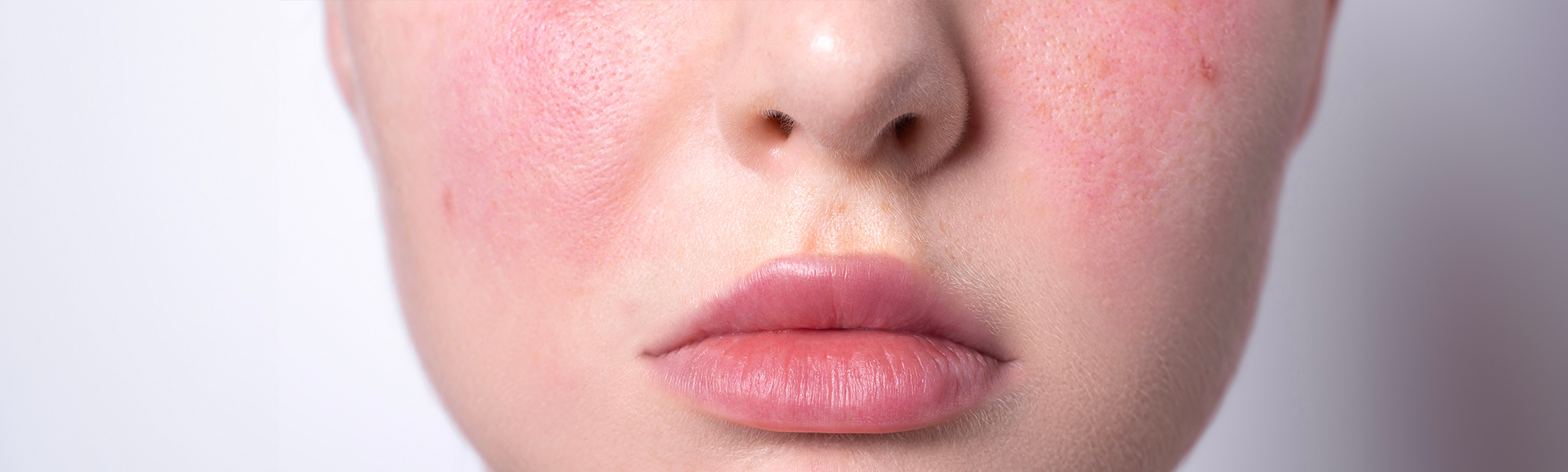 Rosacea