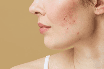 Close-up profile showing cheek blemishes