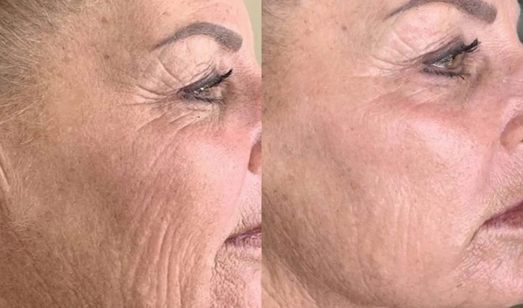 Before and after ADVATx® skin rejuvenation results