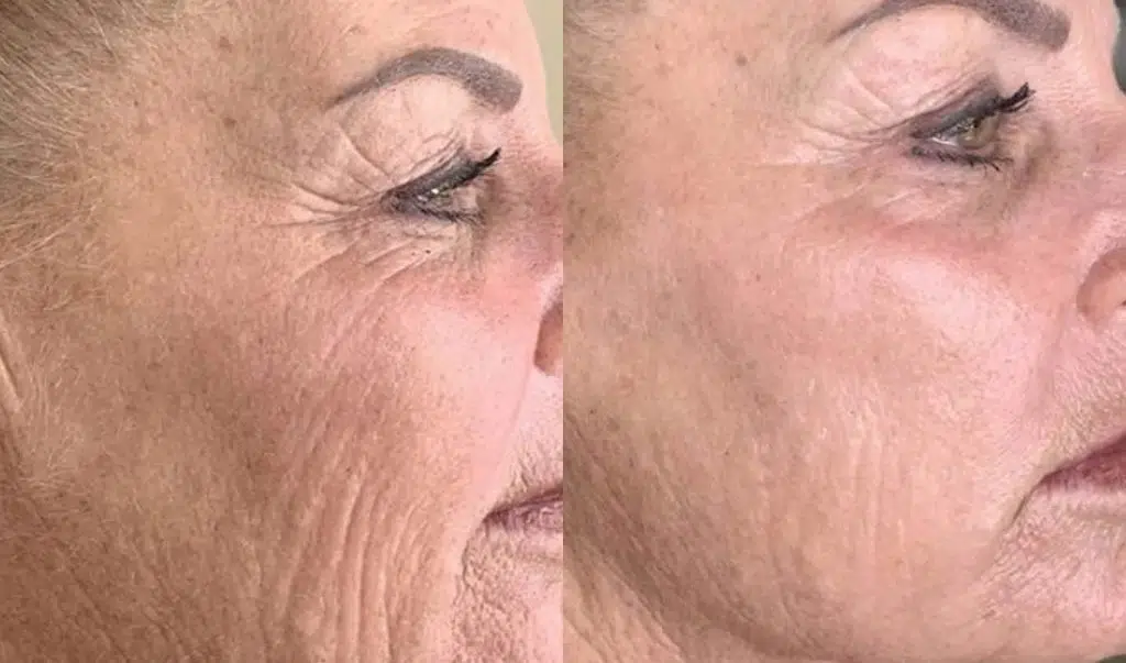 Before and after ADVATx® skin rejuvenation results