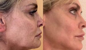 Before and after ADVATx® skin rejuvenation results