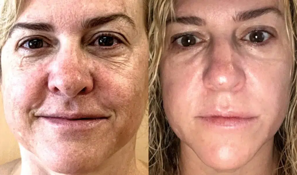Before and after ADVATx® skin rejuvenation results